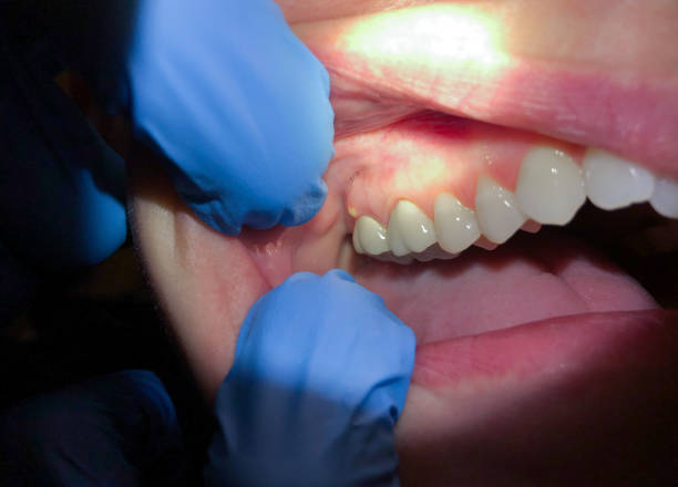 Best Dentist for Tooth Abscess  in Westminster, CA